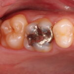 つめ物の下にできたむし歯