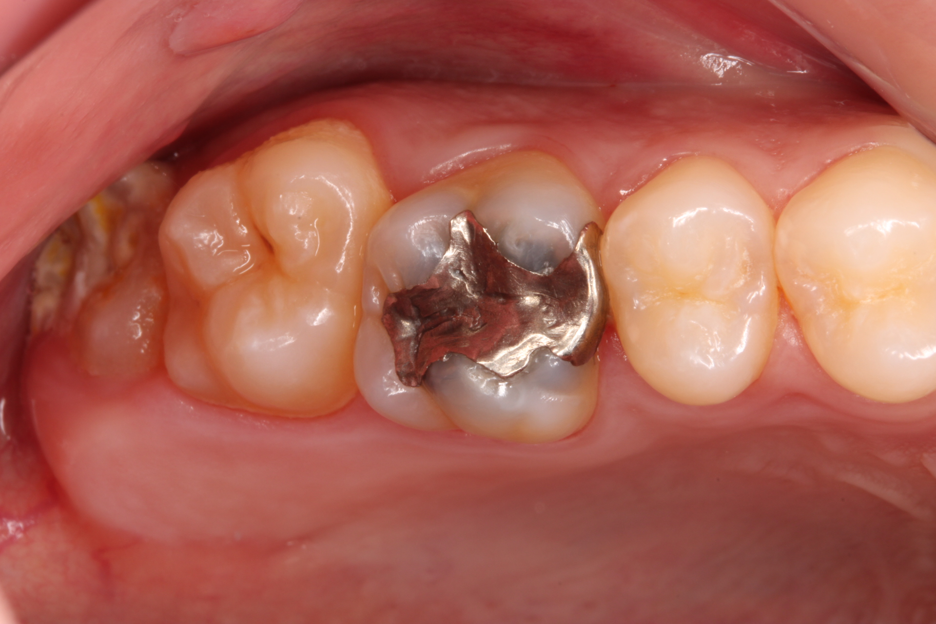 つめ物の下にできたむし歯
