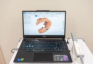 口腔内スキャナー