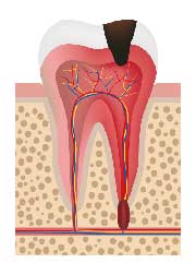 歯の根(歯質)が失われた歯