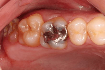 銀歯の下にう蝕が認められる