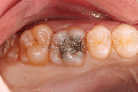 銀歯を除去