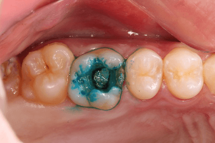 むし歯の組織を染め出す薬剤（う蝕検知液）で染色