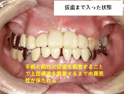 治療経過(口腔内写真)