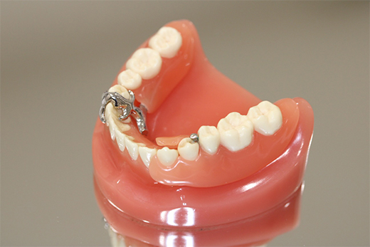 入れ歯治療