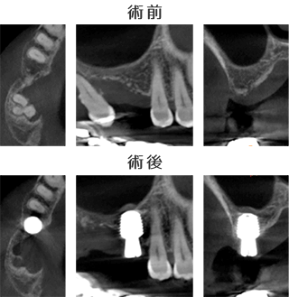 術前術後のCT比較