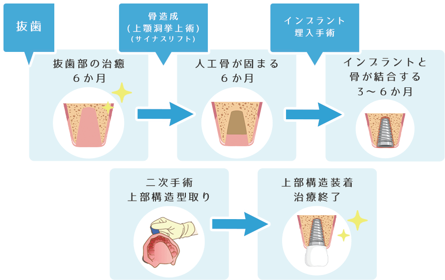 一般的なインプラント治療の流れ